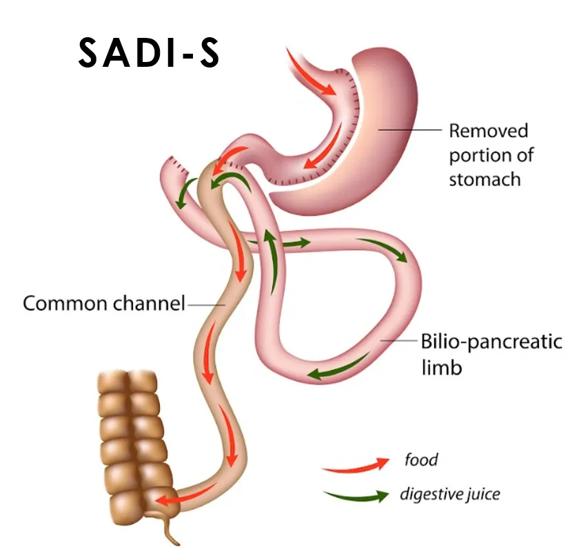 hypoabsorption-weight-loss